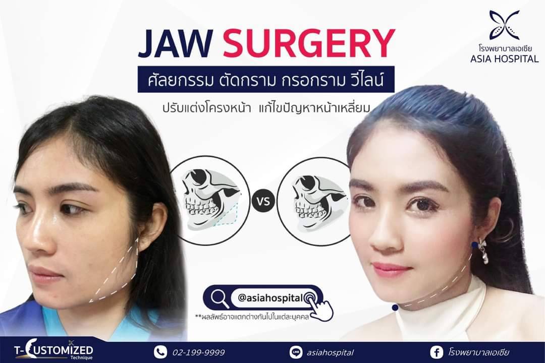 So Young ตัดกราม กรอกราม ลดหน้าเหลี่ยม หน้าบาน เพื่อกรอบหน้าเรียวสวย - Asia  Cosmetic Hospital